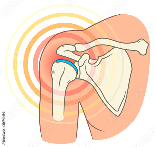 Shoulder joint pain