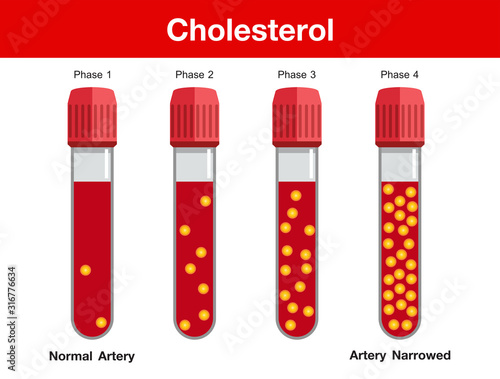 Cholesterol in artery, health risk , vector design