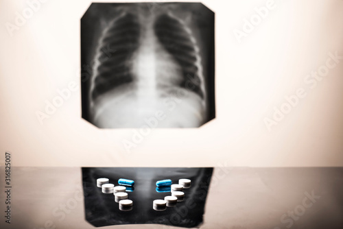 tuberculosis treatment concept. X-ray of the lungs, with pathology, phonendoscope with pills on the table. photo