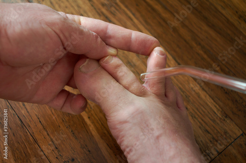 treatment of nail fungus 1