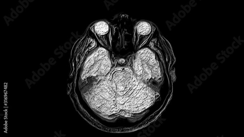 Voluminous MRI scans of the brain and head to detect tumors. Diagnostic medical tool