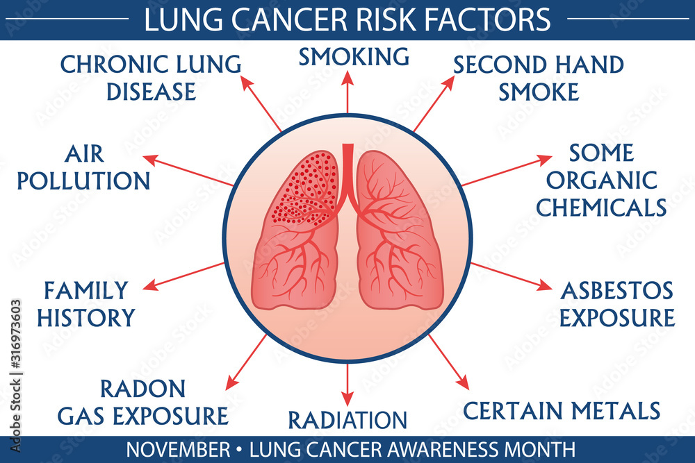 Lung cancer risk factor infographic vector illustration. Health and