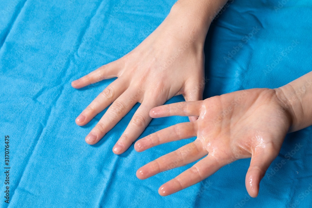 Fototapeta premium Close up of hands on a towel,one facing up and the other facing down. Hyperhidrosis problem, excessive sweating