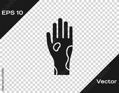 Grey Hand with psoriasis or eczema icon isolated on transparent background. Concept of human skin response to allergen or chronic body problem. Vector Illustration