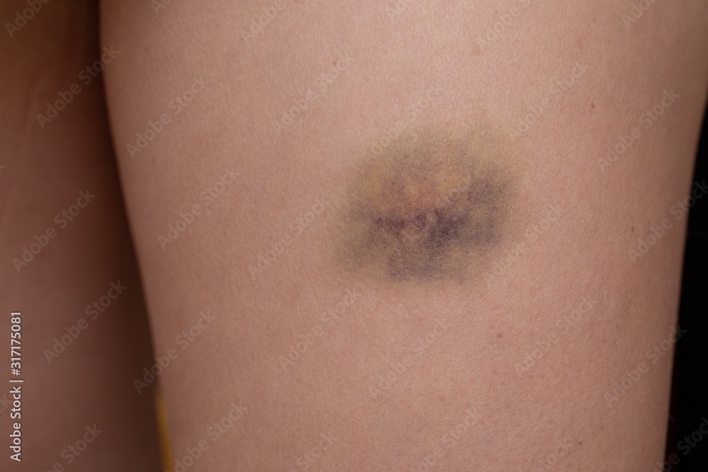 Detail of forearm with a big bruise Detail of forearm with a big bruise
