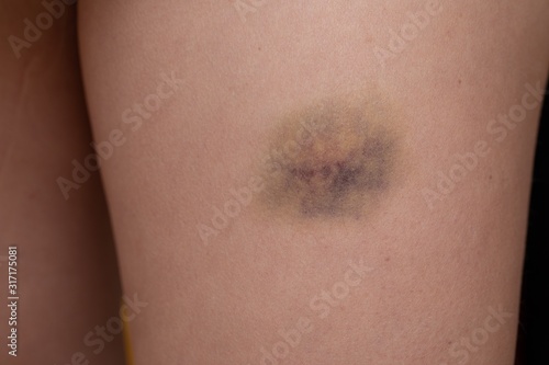 Detail of forearm with a big bruise photo