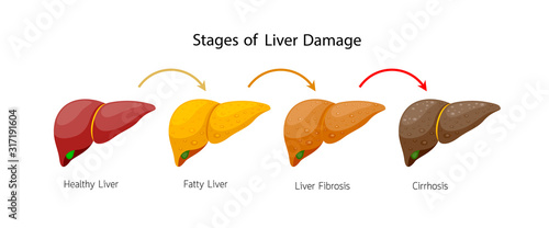 Stages of liver damage. Liver Disease. Healthy, fatty, fibrosis and Cirrhosis. Info-graphic, vector illustration isolated on white background.
