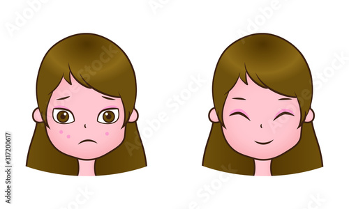 ニキビが治った女性