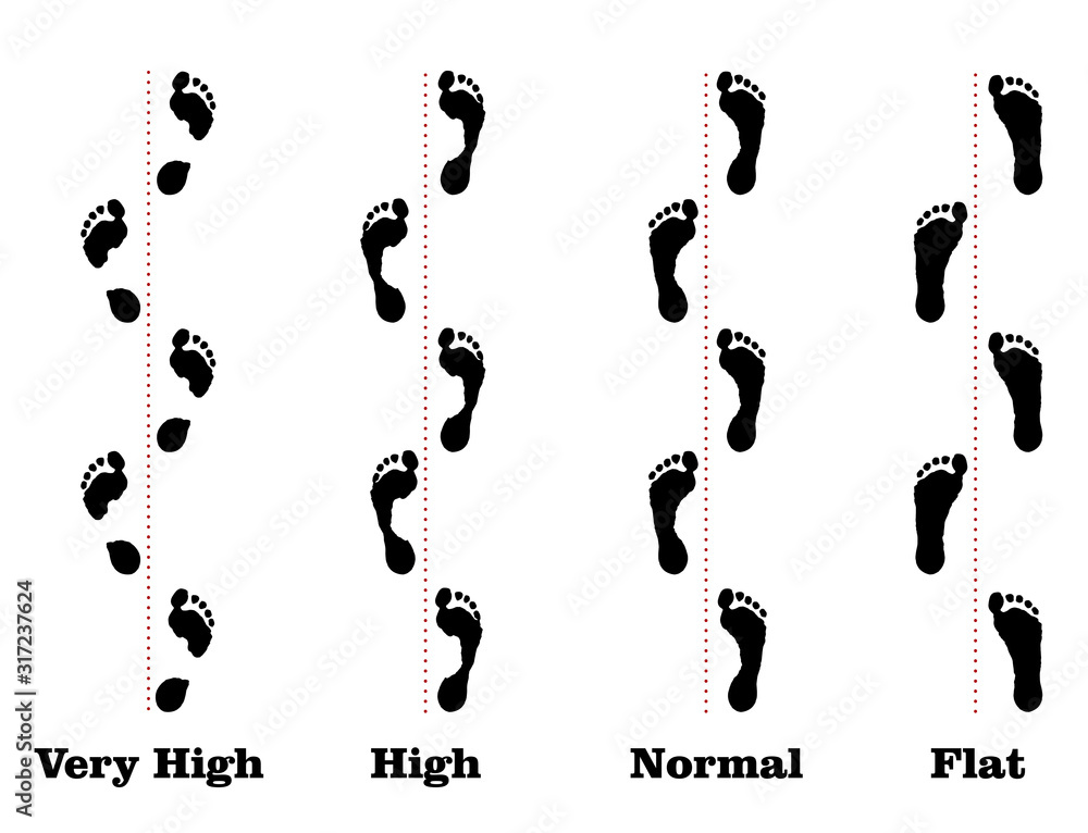 Flatfoot. 4 footprints of a person with varying degrees of flat feet