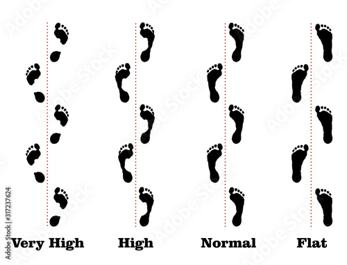 Flatfoot. 4 footprints of a person with varying degrees of flat feet.