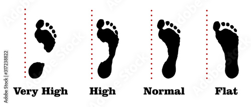 Flatfoot. 4 footprints of a person with varying degrees of flat feet. photo