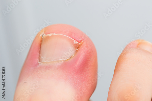 Φωτογραφία close-up photo of a toenail infection in human