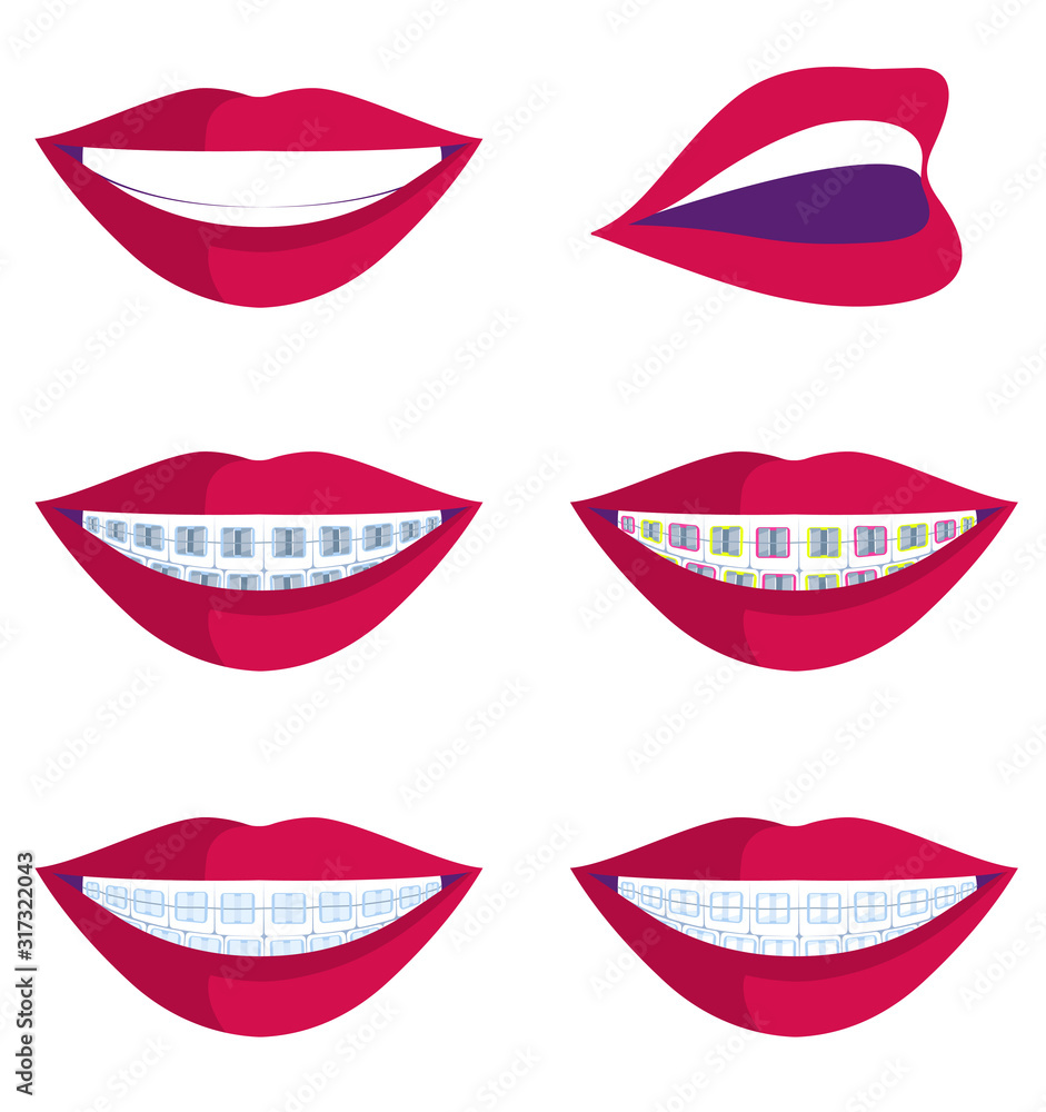 Obraz premium vector illustration of smiles with different types of braces