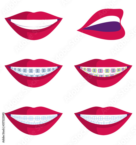 vector illustration of smiles with different types of braces