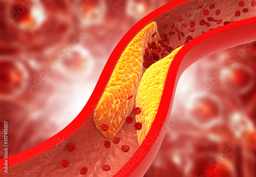Clogged arteries, Cholesterol plaque in artery. 3d illustration photo