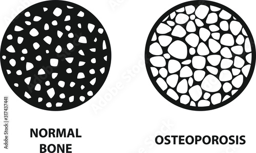 Osteoporosis icon ,Bone structure, vector illustration