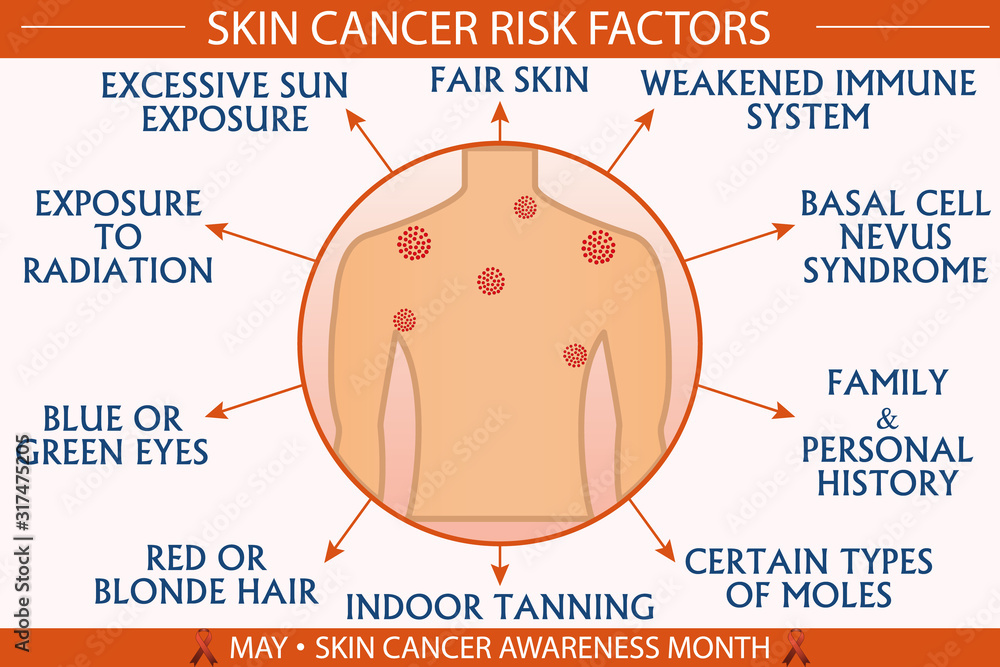 Skin cancer risk factor infographic vector illustration. Health and healthcare concept design 