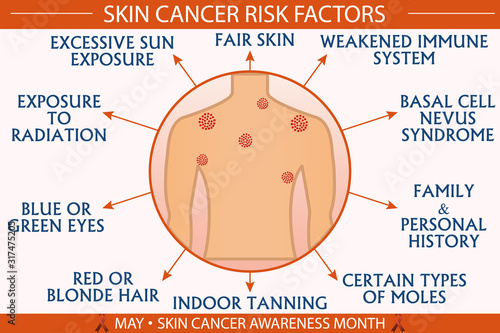 Skin cancer risk factor infographic vector illustration. Health and healthcare concept design for presentation, banner, brochure, etc. EPS-10 vector, printable cmyk colors.