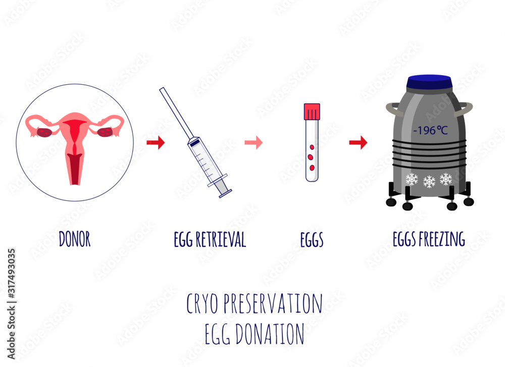 Cryo preservation of eggs. Egg donation. Egg retrieval. Scheme of egg