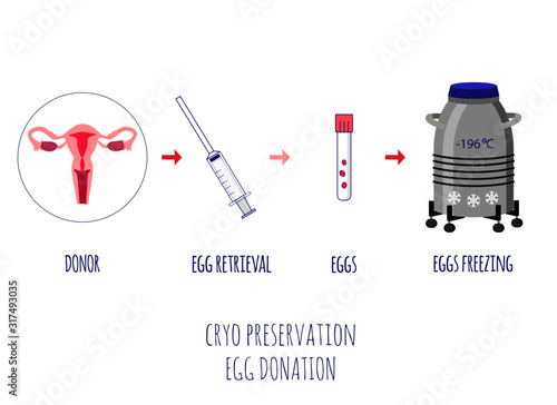 Cryo preservation of eggs. Egg donation. Egg retrieval. Scheme of egg donation and eggs freezing. Vector illustration.