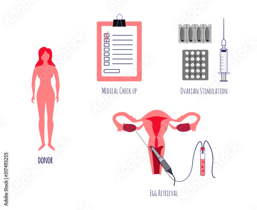 Egg donation. Egg retrieval. Stages of donor preparation. In vitro fertilization.Vector illustration.