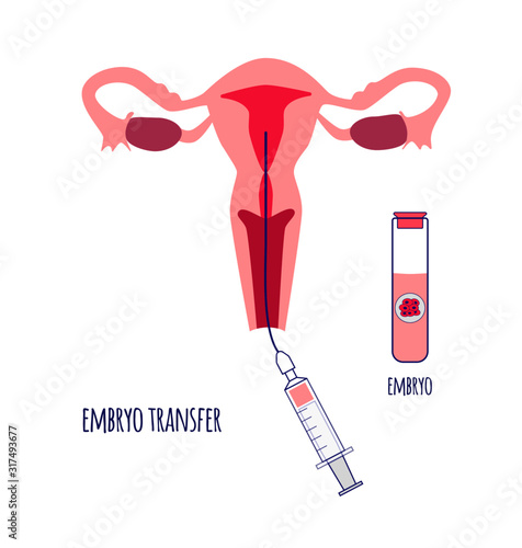 Embryo transfer by syringe with catheter. Egg donation. In vitro fertilization.Vector illustration.
