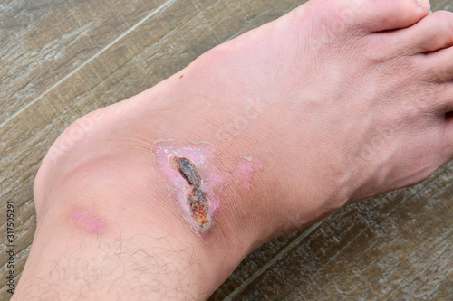 Fotografi Closeup human foot with scab wound texture