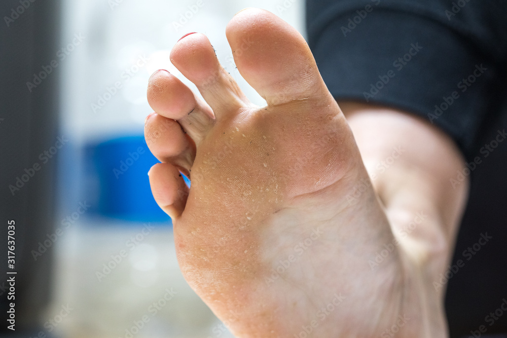 Pitted keratolysis is a bacterial skin infection on the feet Stock