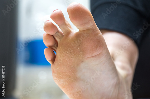 Pitted keratolysis is a bacterial skin infection on the feet photo