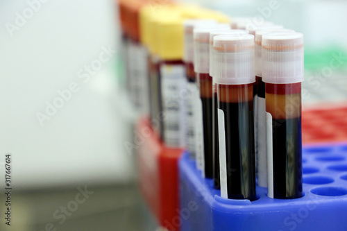 Vials of blood in the medical laboratory. Concept of blood test  donation  vaccination  coronavirus  health care