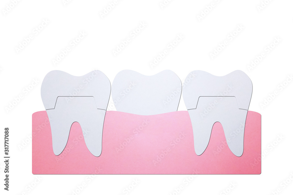 dental crown with bridge, installation process and change of teeth - tooth cartoon paper cut style dental crown with bridge, installation process and change of teeth - tooth cartoon paper cut style