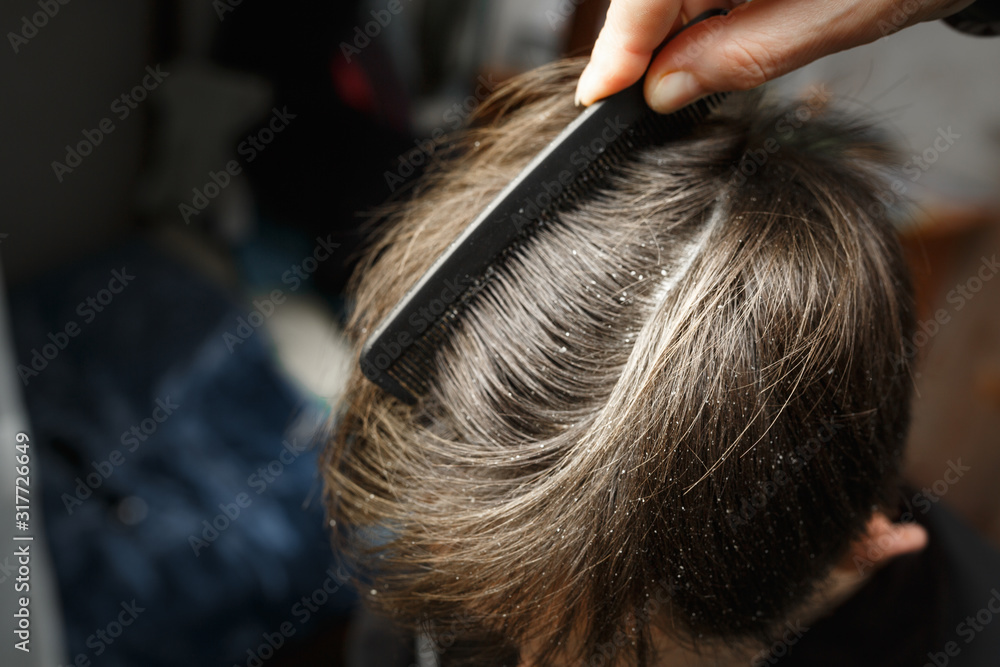 Obraz premium dandruff on the head of dark-haired guy