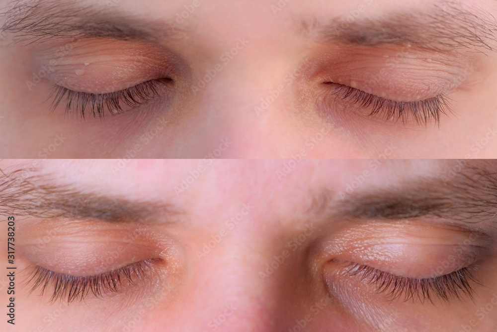 Obraz premium Closed eyes of young man patient before and after laser removal of papillomas on eyelids or skin growths, closeup. View a week later after making laser removing. Result of surgical cure.