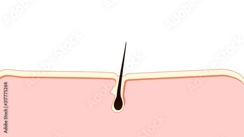 Laser Hair Removal. The laser emits an invisible light which penetrates the skin without damaging it. At the hair follicle, the laser light absorbed by the pigments is converted into heat. 