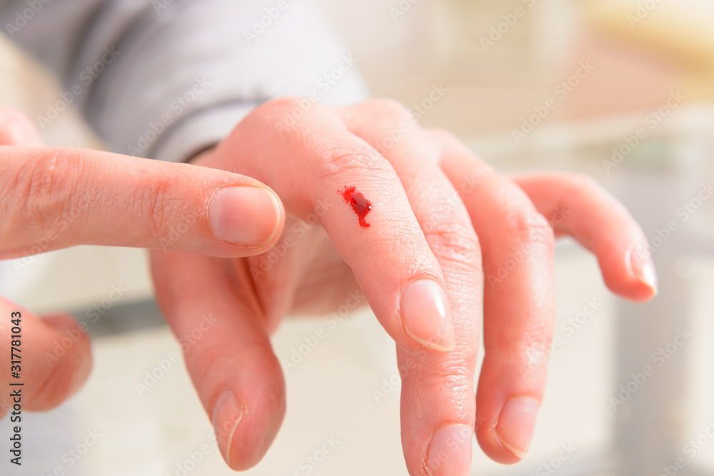 Bleeding finger, hand with a wound Stock Photo Adobe Stock