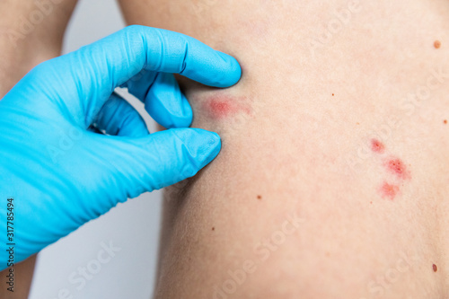 Herpes on body. Skin disease. Professional doctor examining skin of a patient.