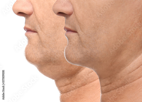 Mature man before and after plastic surgery operation on white background, closeup. Double chin problem