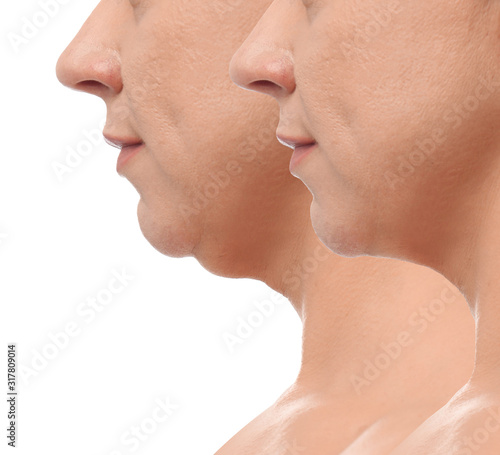 Mature woman before and after plastic surgery operation on white background, closeup. Double chin problem