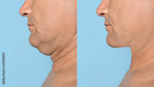 Mature man before and after plastic surgery operation on blue background, closeup. Double chin problem