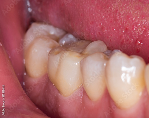 dental treatment for single crown