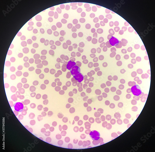 Immature cell or bast cell in leukemia patiens. photo