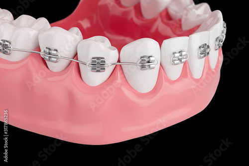 Close up Process Health Teeth with Brace. Selective focus. 3D Render. photo