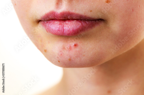 Female face with acne skin problem