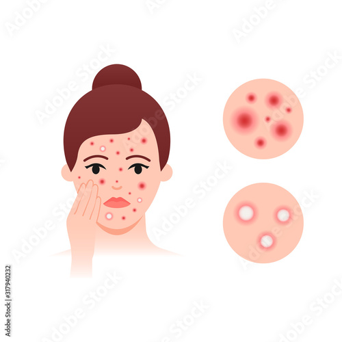 Skin problems acne vector illustration