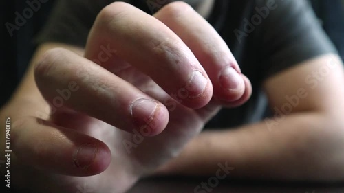 Close view of male hands with strongly bitten nails. Finger selection with alarm. Ugly bitten fingers, cuticles, wounds on the fingers. Bad habit. The concept of onychophagy and dermatophagy. photo