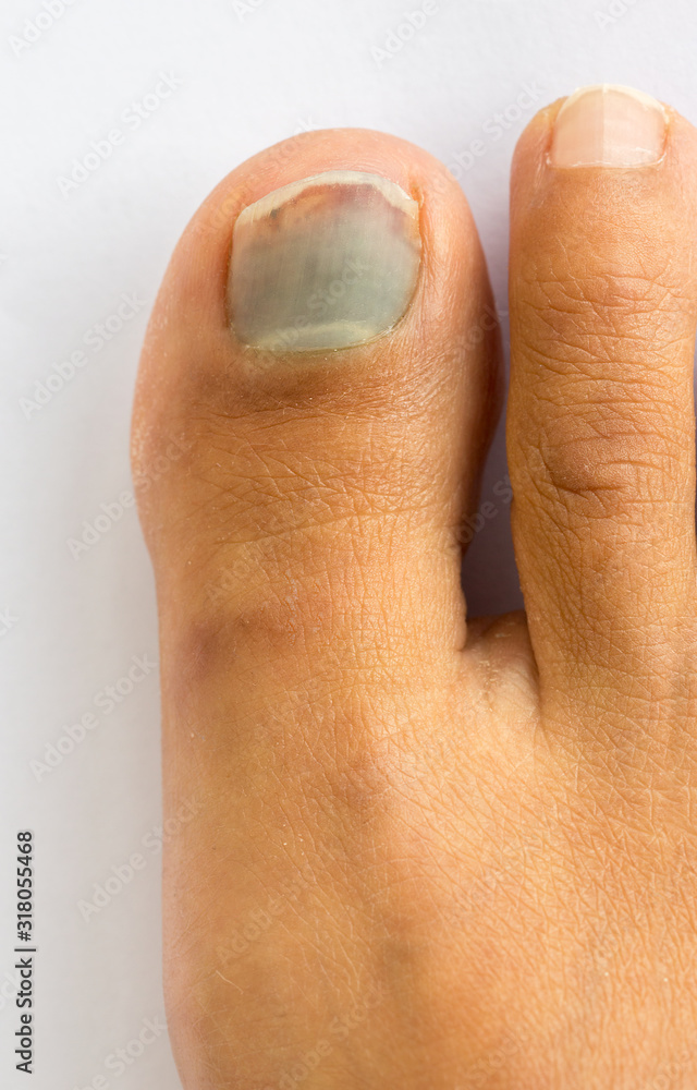 subungual hematoma blue and black toe nail Stock Photo | Adobe Stock