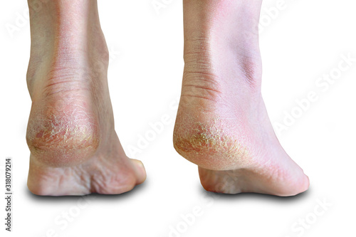 skin dry on the heels skin disease cracks white background