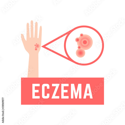 sign of eczema-affected hand