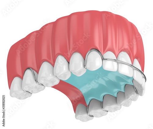 3d render of jaw with orthodontic removable retainer photo