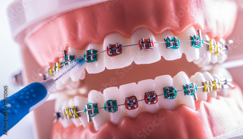 Tooth model from dental braces with inter dental teeth cleaning brush